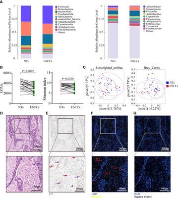 Intratumoral microbiome impacts immune infiltrates in tumor microenvironment and predicts prognosis in esophageal squamous cell carcinoma patients